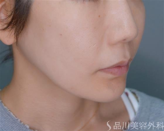 症例NO.51779のBEFORE写真