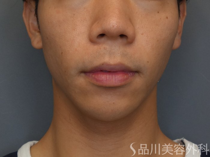 症例NO.74994のBEFORE写真