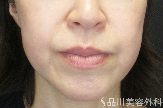 症例NO.69430のBEFORE写真