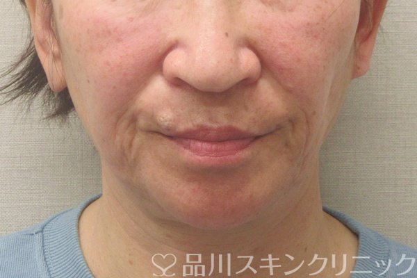 症例NO.75165のBEFORE写真