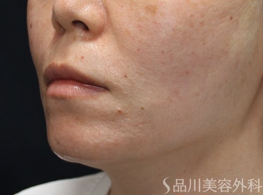 症例NO.74960のAFTER写真