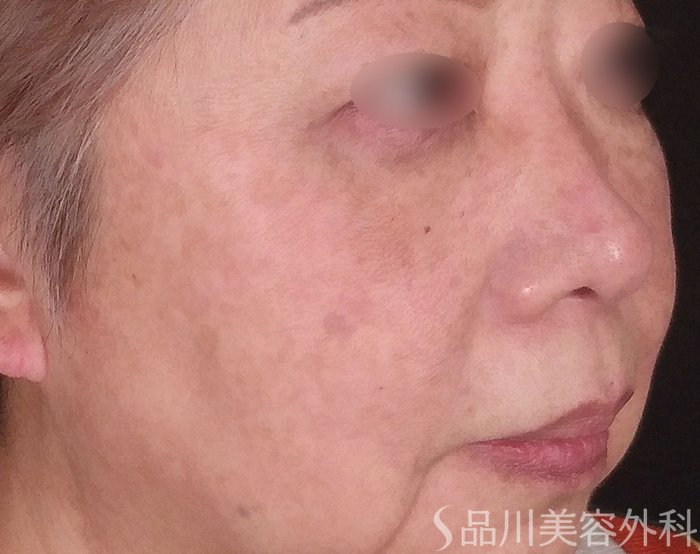 症例NO.69454のAFTER写真