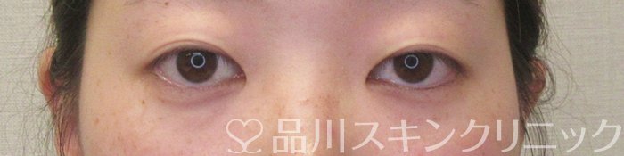 症例NO.74203のBEFORE写真