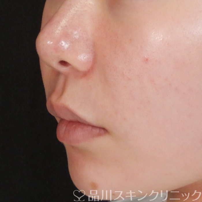 症例NO.63105のBEFORE写真