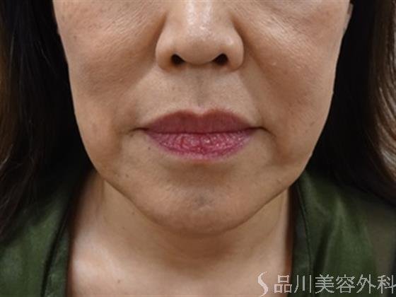 症例NO.40844のBEFORE写真