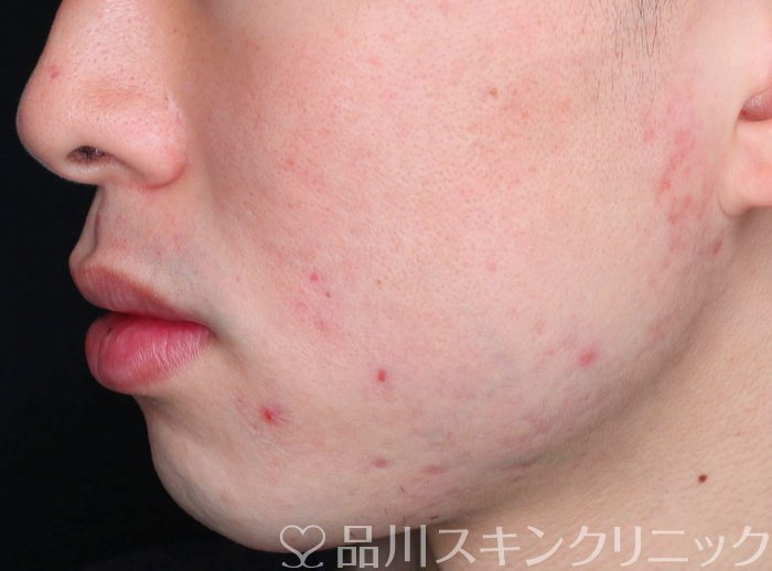 症例NO.73654のAFTER写真