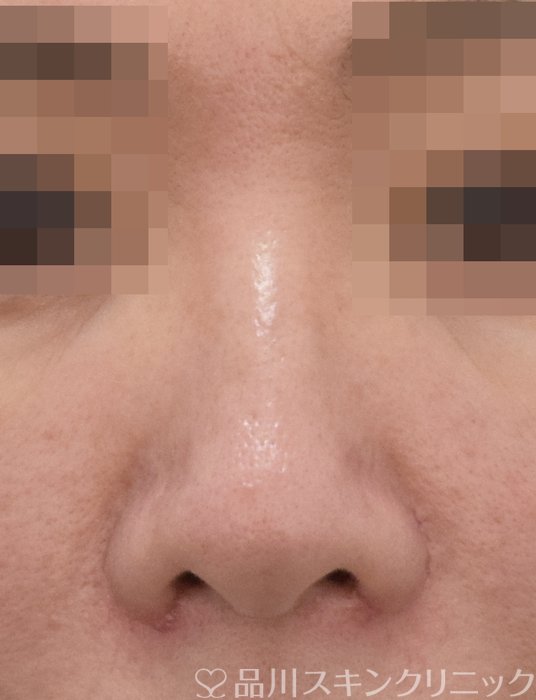 症例NO.73335のAFTER写真