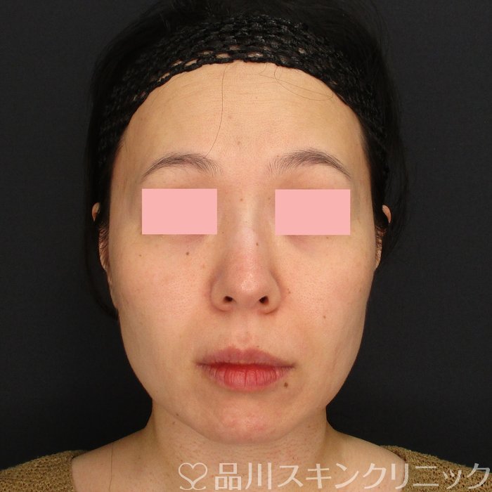 症例NO.71794のBEFORE写真