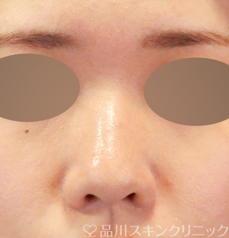 症例NO.64565のBEFORE写真