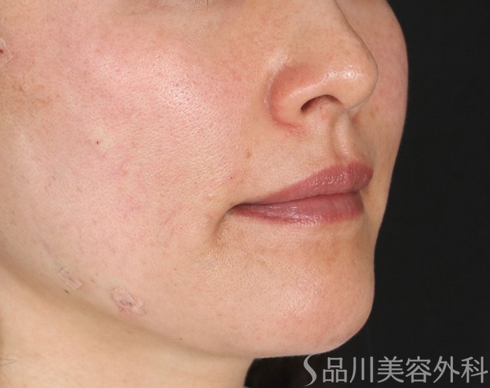 症例NO.72322のAFTER写真