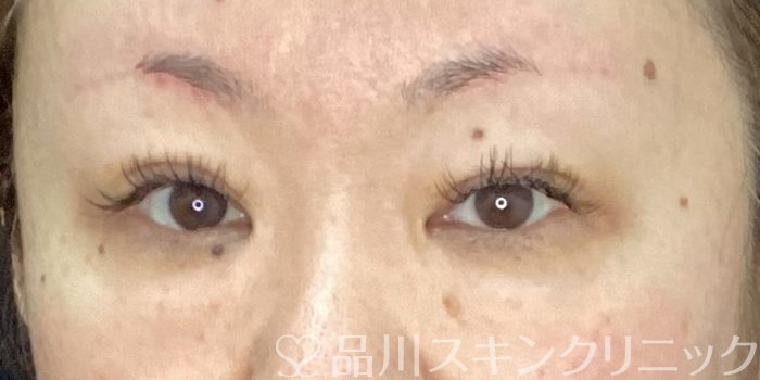 症例NO.70439のAFTER写真