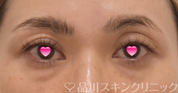 症例NO.74276のBEFORE写真