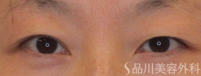 症例NO.65686のBEFORE写真