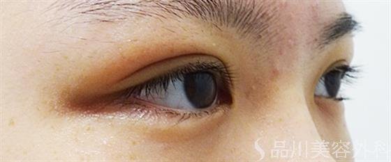 症例NO.48848のAFTER写真