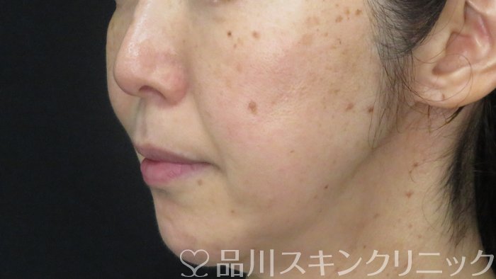 症例NO.71744のBEFORE写真