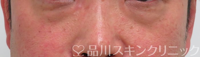 症例NO.65292のBEFORE写真