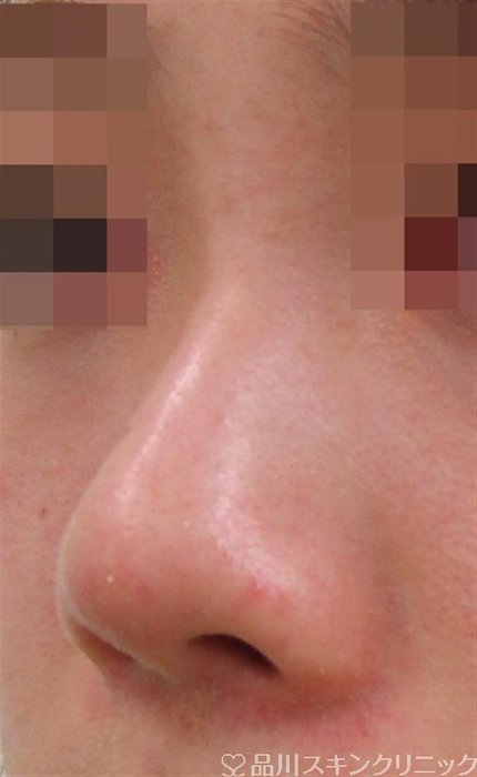 症例NO.32662のBEFORE写真