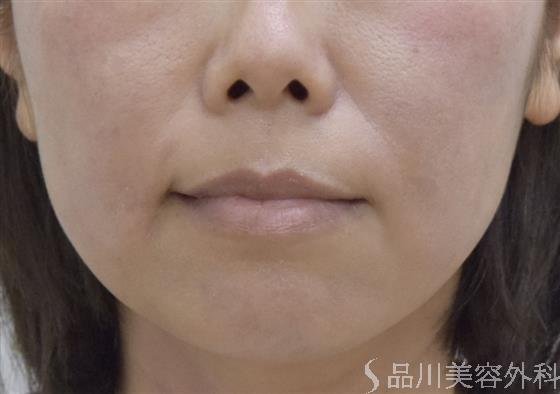 症例NO.48900のBEFORE写真