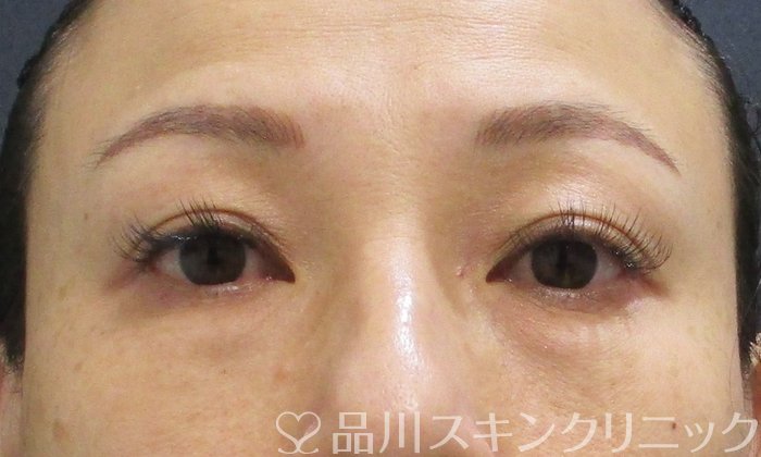 症例NO.67694のBEFORE写真