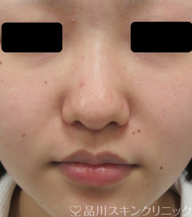 症例NO.73980のBEFORE写真