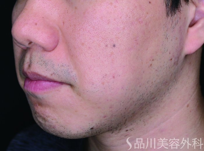 症例NO.70257のAFTER写真