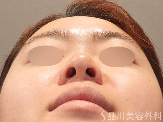 症例NO.75108のAFTER写真