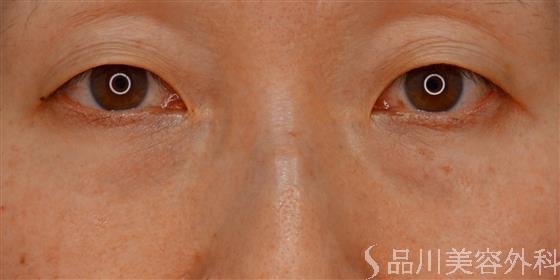 症例NO.60479のBEFORE写真