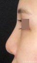 症例NO.71699のBEFORE写真