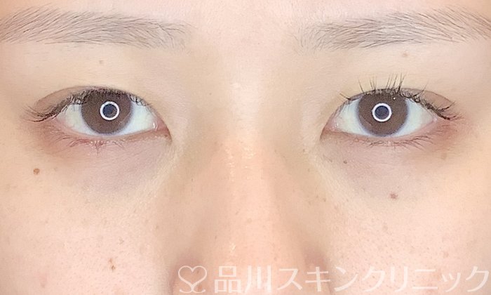 症例NO.69611のBEFORE写真