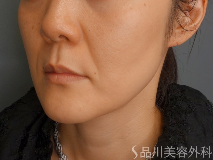 症例NO.62282のBEFORE写真