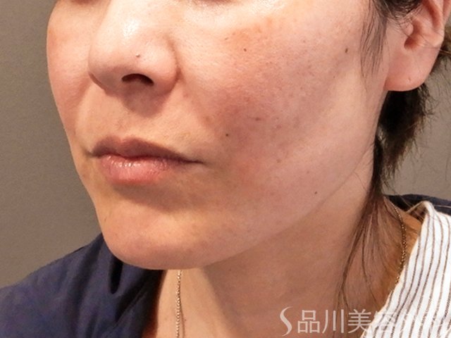 症例NO.70824のBEFORE写真