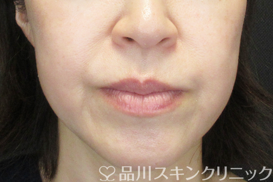 症例NO.69430のBEFORE写真