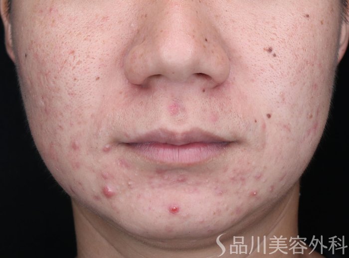 症例NO.71439のBEFORE写真