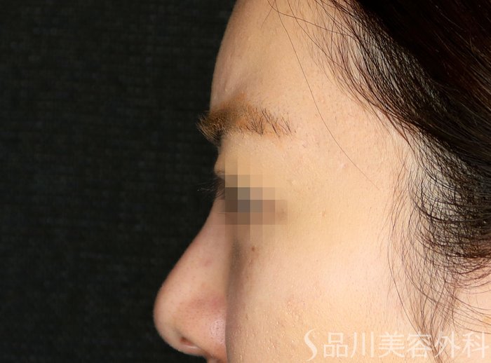 症例NO.71109のBEFORE写真