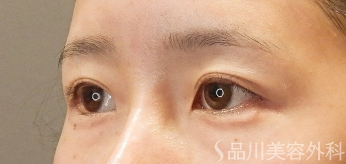 症例NO.68027のAFTER写真