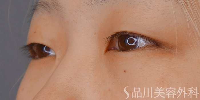 症例NO.71829のBEFORE写真