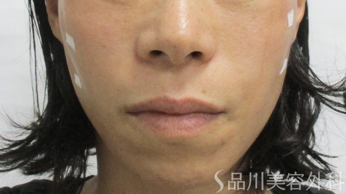 症例NO.63995のAFTER写真