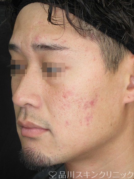 症例NO.67745のBEFORE写真