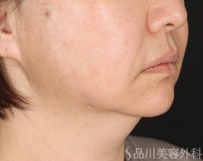 症例NO.73612のAFTER写真