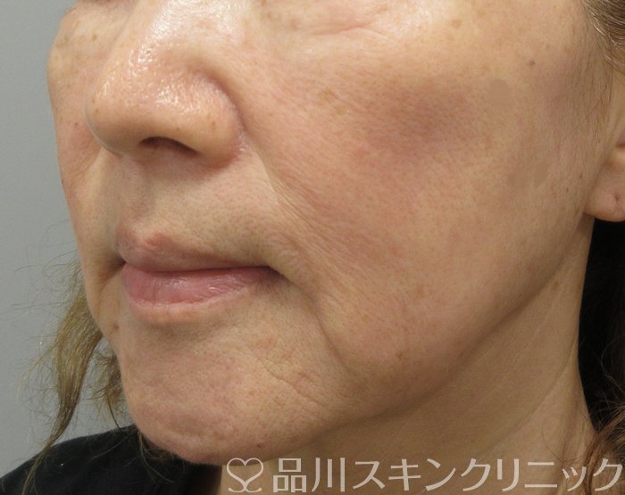 症例NO.72090のBEFORE写真