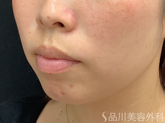 症例NO.67893のBEFORE写真