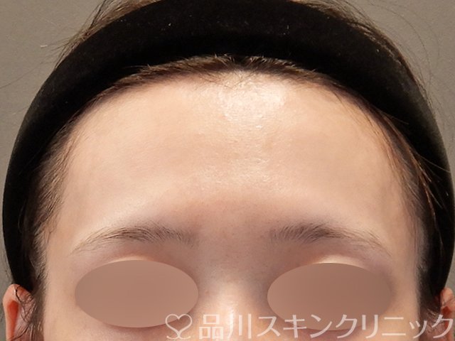 症例NO.75351のBEFORE写真
