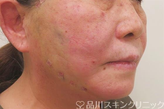 症例NO.42982のAFTER写真
