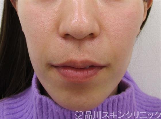 症例NO.50248のBEFORE写真