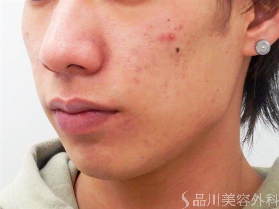 症例NO.60485のBEFORE写真