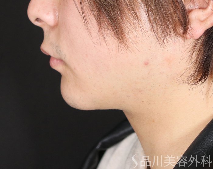 症例NO.72750のBEFORE写真