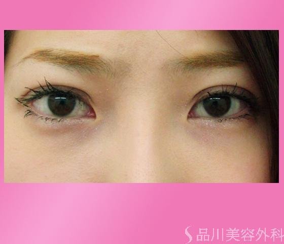 症例NO.1243のAFTER写真