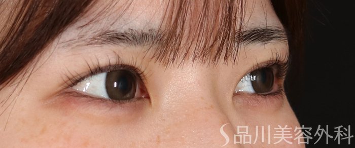 症例NO.74158のBEFORE写真