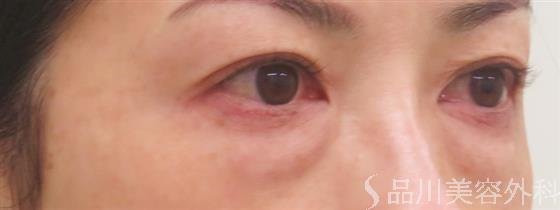 症例NO.58414のBEFORE写真