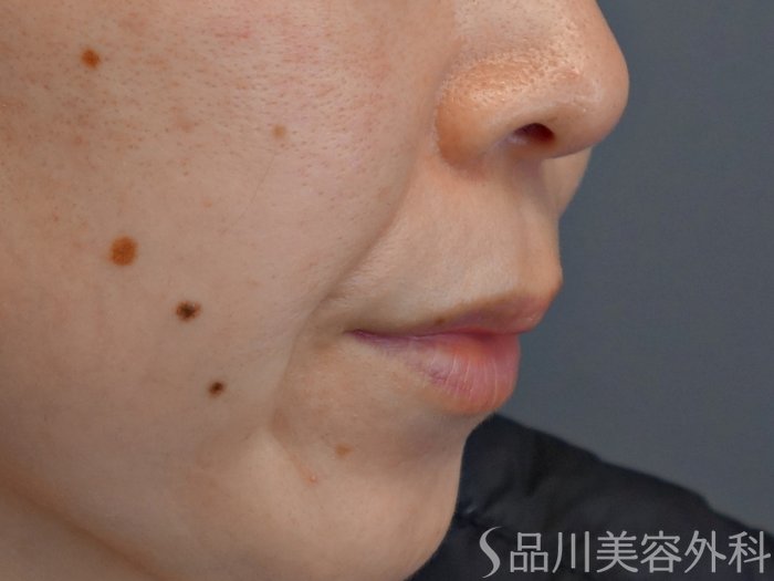 症例NO.72592のBEFORE写真